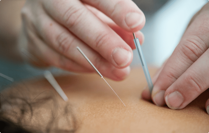 A person is using acupuncture needles on the back of their body.