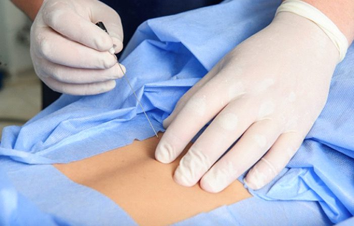 A person is sewing on the arm of someone.
