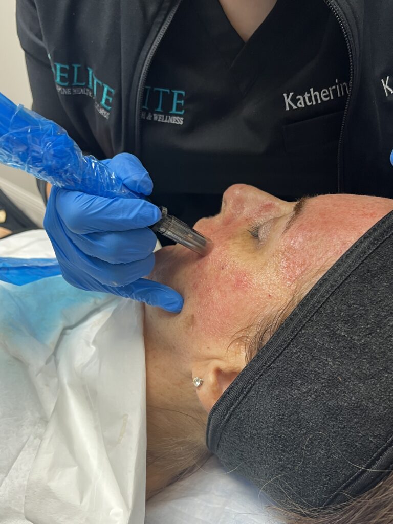 A person is getting their face waxed