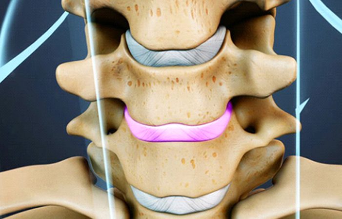 Motion-sparing-surgery